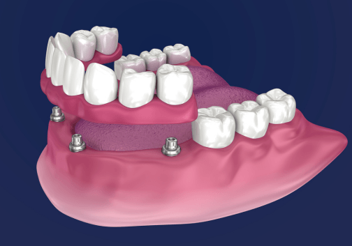 Denture Stabilization near Assaria, KS